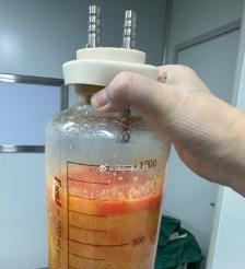 阜阳水动力吸脂手术要做多久？